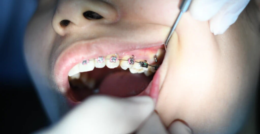 dental teeth